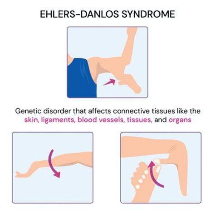 At what age is Ehlers-Danlos syndrome diagnosed?