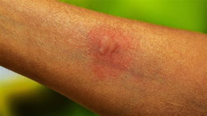 Can a mosquito live after biting you?
