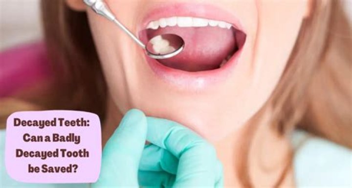Can a rotting tooth be saved?