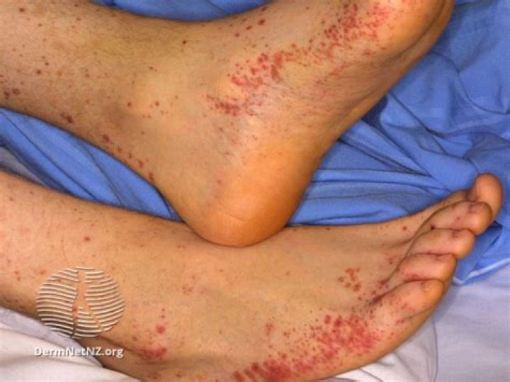 Can Covid bring on vasculitis?