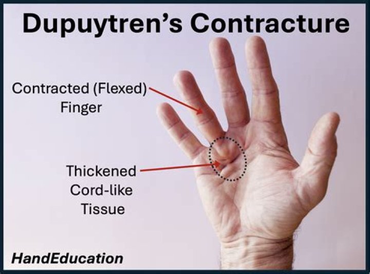 Can Dupuytren's contracture be reversed without surgery?