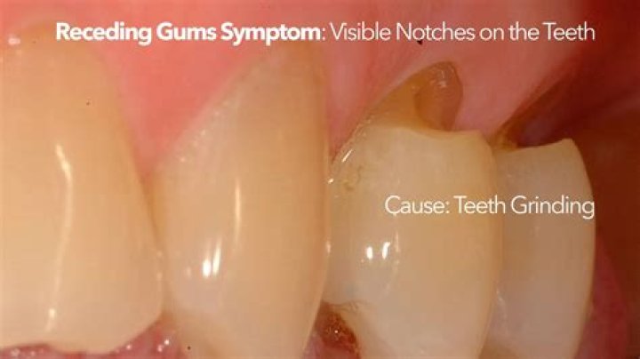 Can gums temporarily recede?