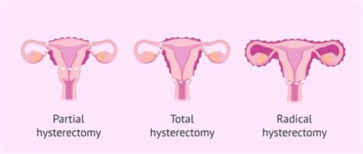 Can HPV come back after hysterectomy?