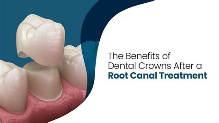 Can I brush my teeth after root canal with temporary filling?