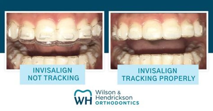 Can I leave my Invisalign out for 2 hours?
