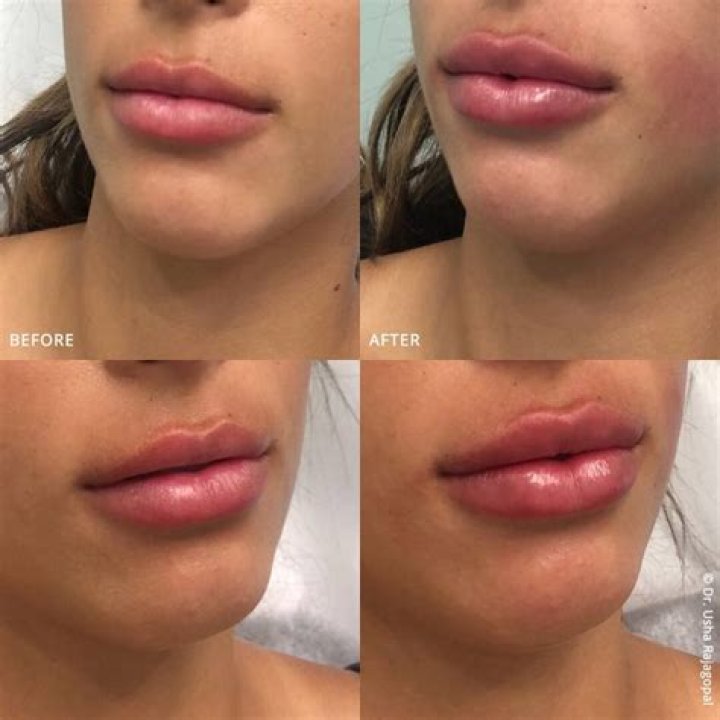 Can lip lift be done with fillers?