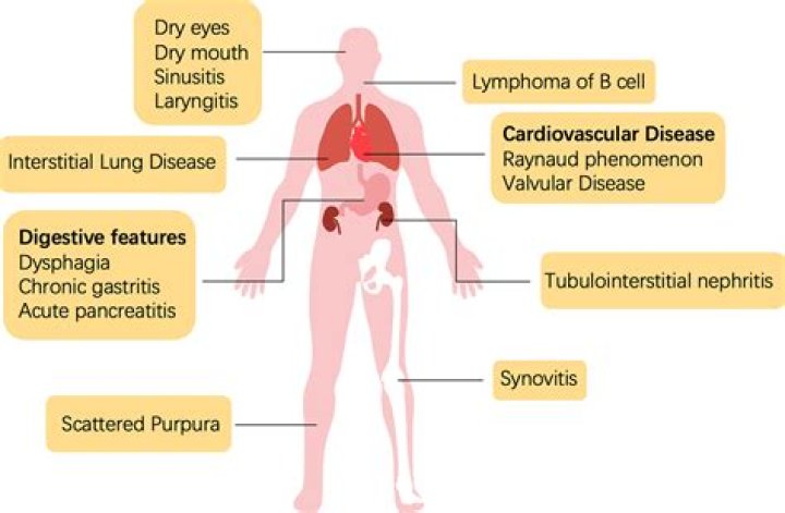 Can sjogrens affect your stomach?