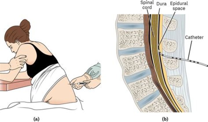 Can you breastfeed after epidural?