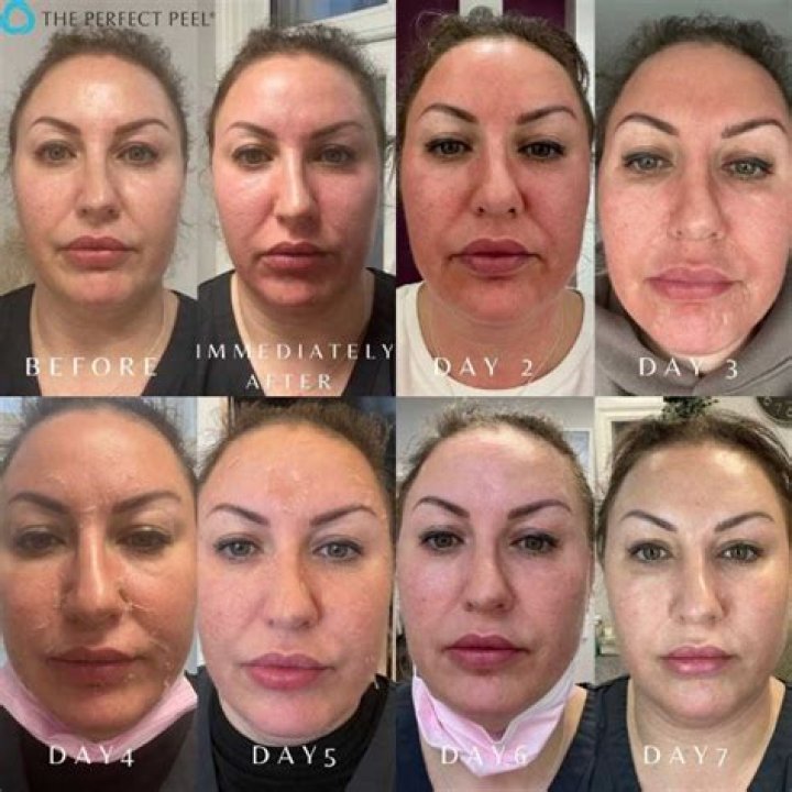 Can you see results after 1 peel?