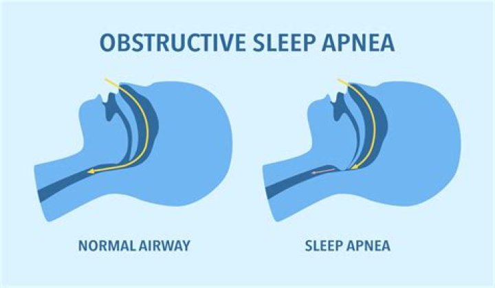 Does air quality affect snoring?
