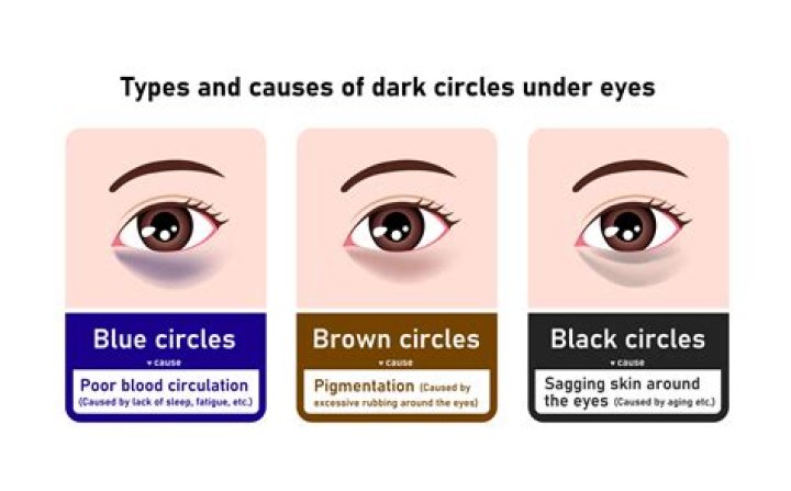 Does alcohol cause dark circles under eyes?