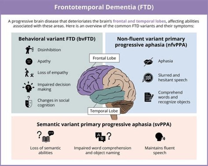 Does ALS cause dementia?