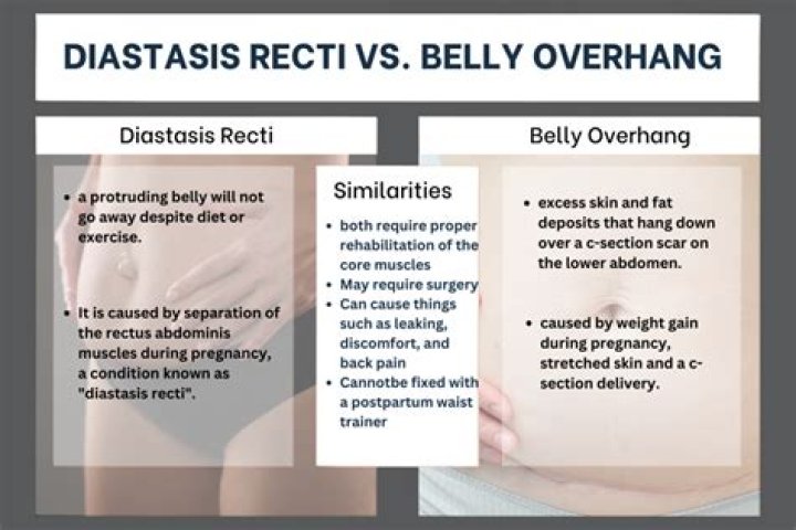 Does C-section bulge go away?