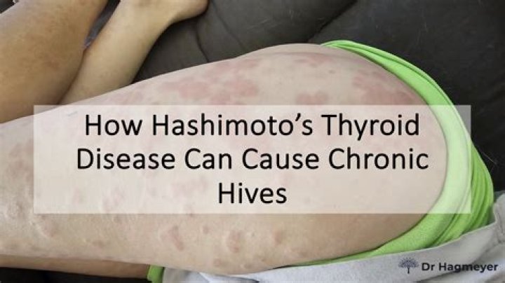 Does Hashimoto's cause leg pain?