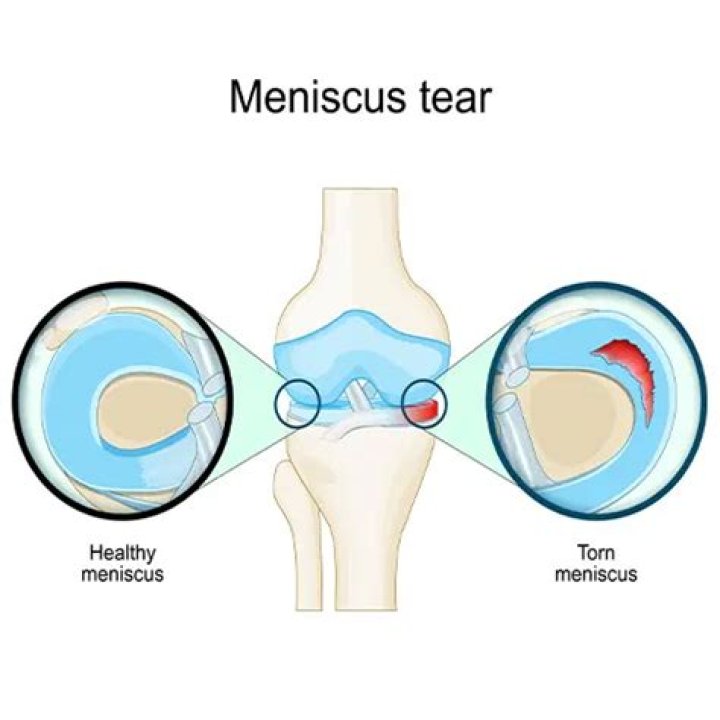 Does meniscus tear hurt to touch?