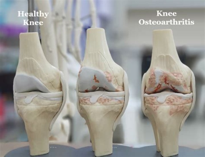 Does osteoarthritis hurt all the time?