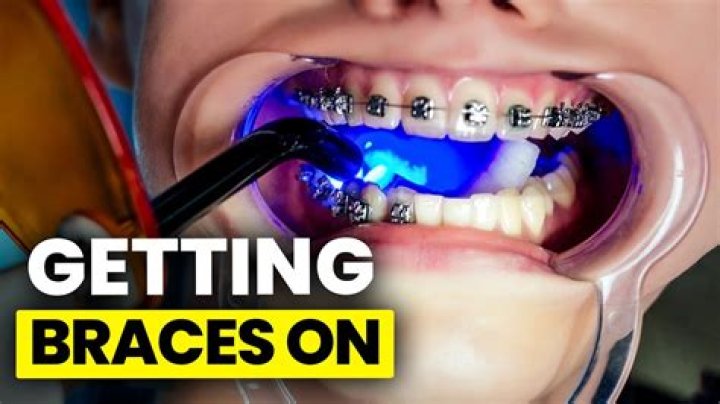 How can I make braces hurt less?