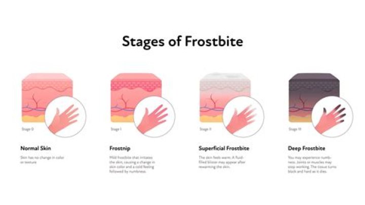 How cold does it have to be for a dog to get frostbite?