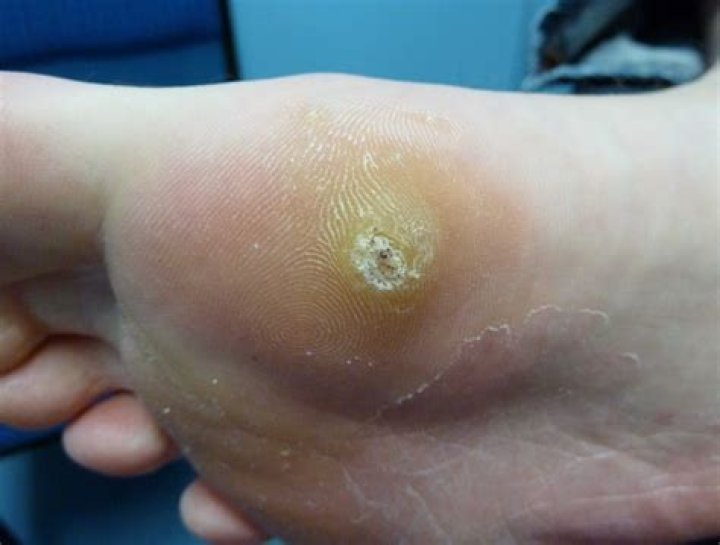 How deep is a plantar wart?