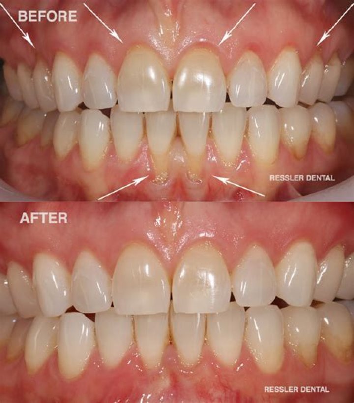 How do you fix severely receding gums?