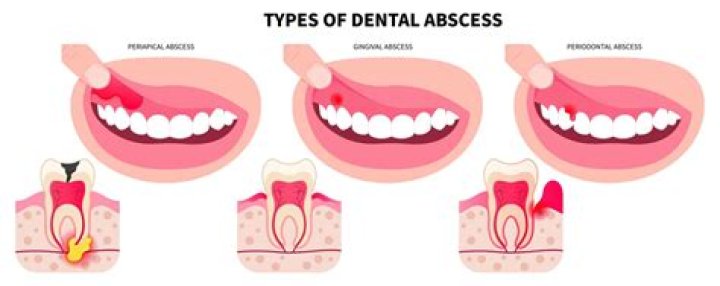 How do you get the swelling down from an abscess?