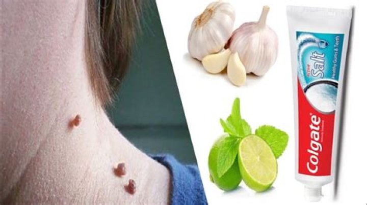 How does Colgate toothpaste remove skin tags?