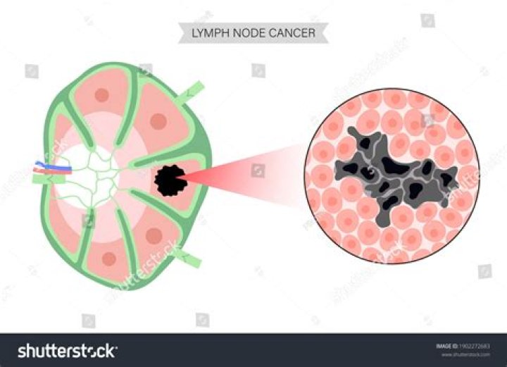 How hard is a cancerous lymph node?