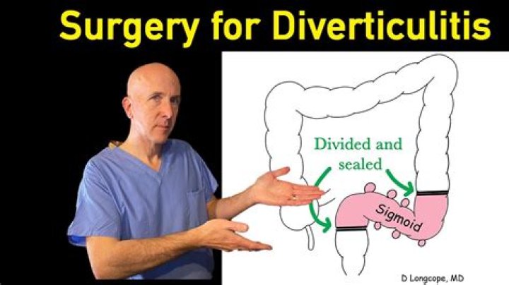 How long after diverticulitis can I have a colonoscopy?