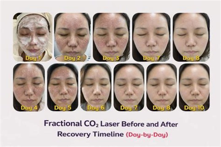 How long does it take to see Fraxel results?