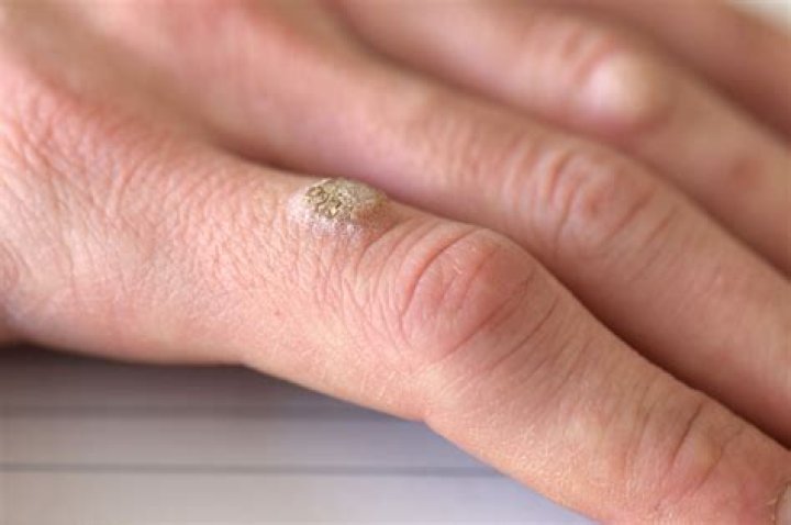 How long does the wart virus live on objects?