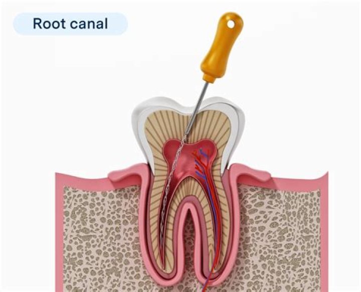 How many root canals can you have on one tooth?