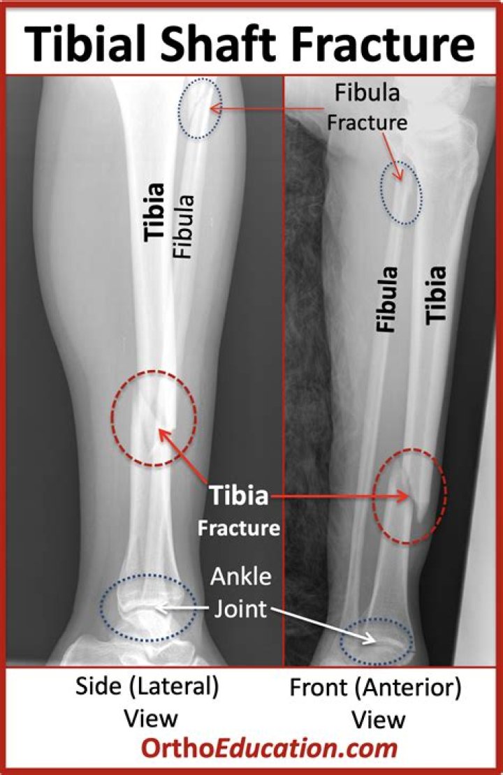 How painful is a broken tibia and fibula?