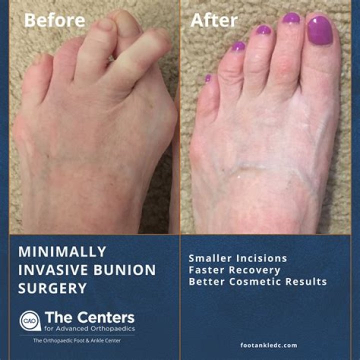 How soon can you put weight on your foot after bunion surgery?