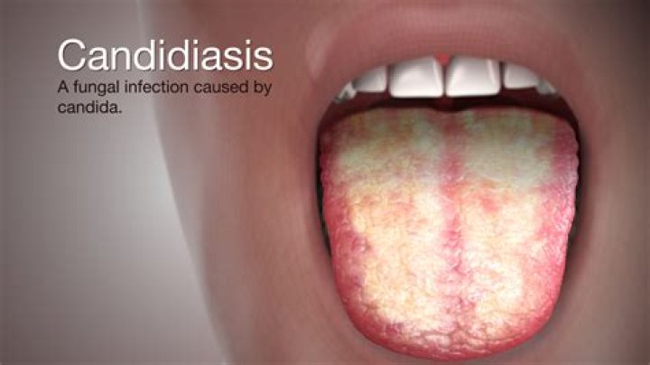 Is Candida a fungus or yeast?