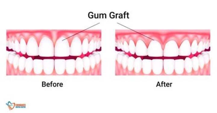 Is gum grafting permanent?