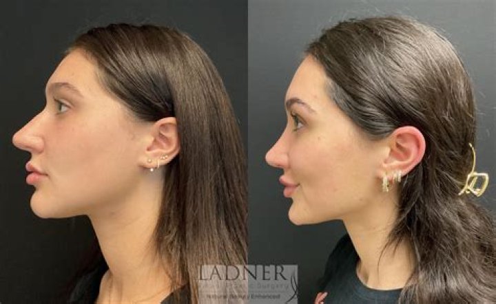 Is it weird to get a nose job?
