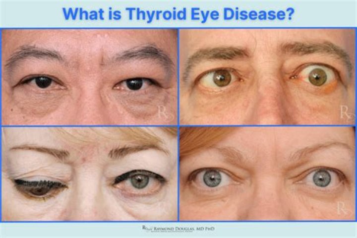 Is there a cure for thyroid eye disease?