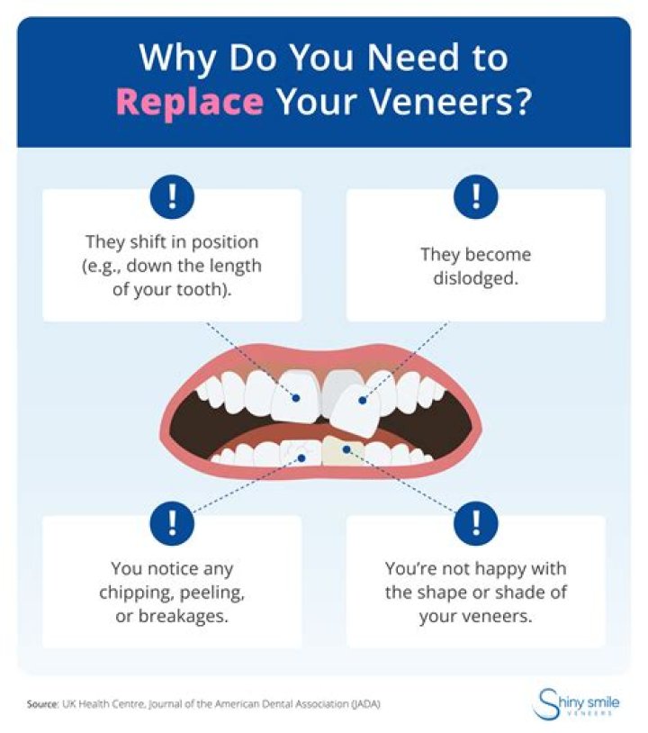 Should veneers be replaced over time?