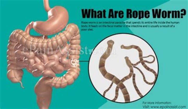 What are rope worms in humans?