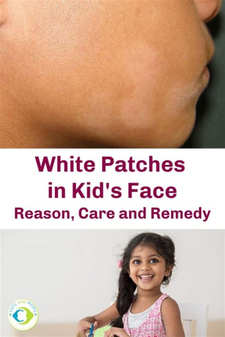 What are the home remedies for white patches on face?