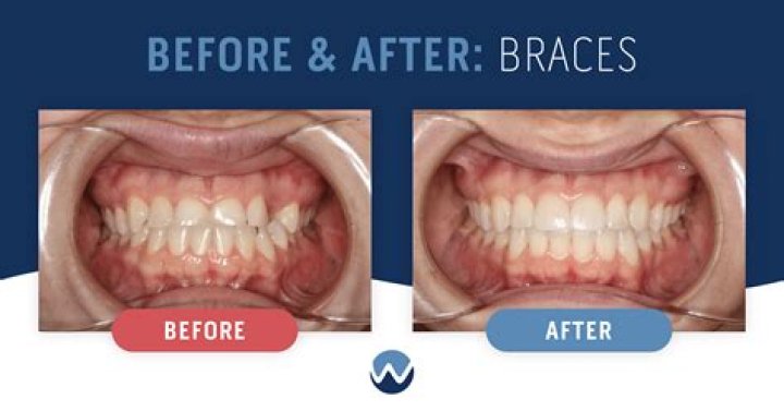 What can't you do with braces?
