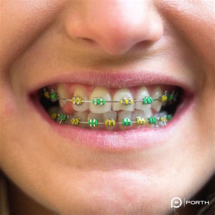 What color braces are most attractive?