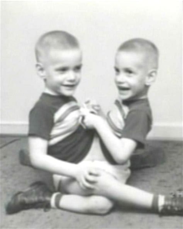 What did the conjoined twins Ronnie and Donnie died from?