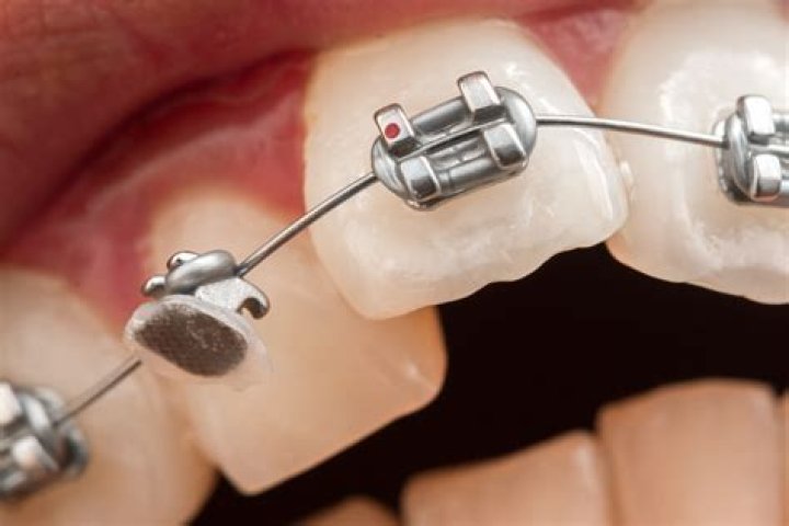 What do braces without wires do?