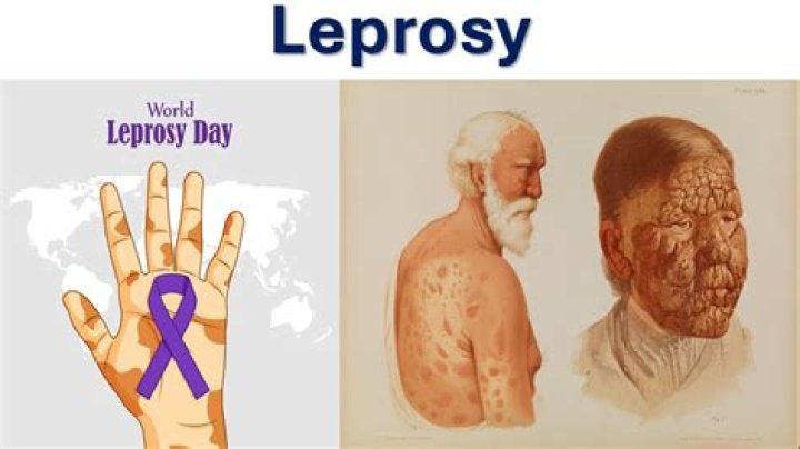 What does a person with leprosy look like?