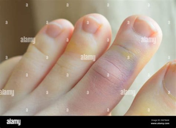 What does a sprained toe look like?