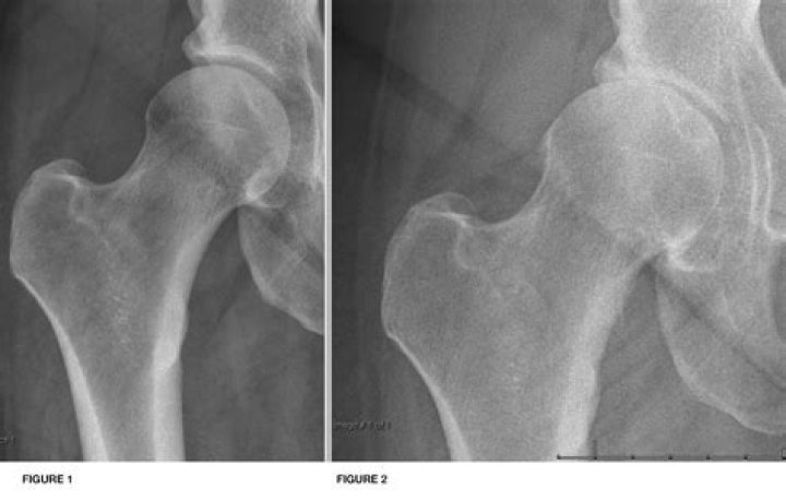 What does hip arthritis feel like?