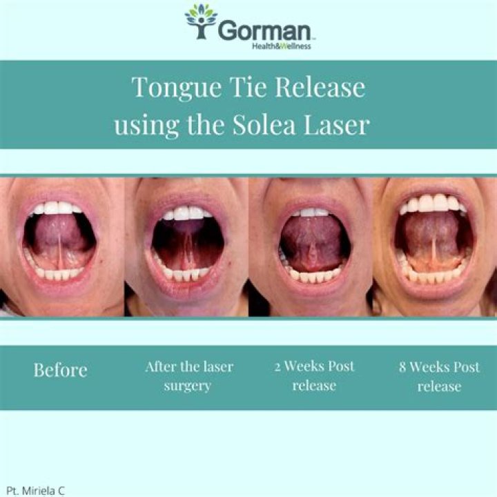 What happens after tongue-tie release in adults?