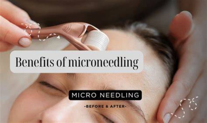 What happens if you microneedle too often?