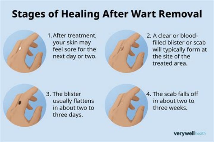 What happens if you pull out a wart?